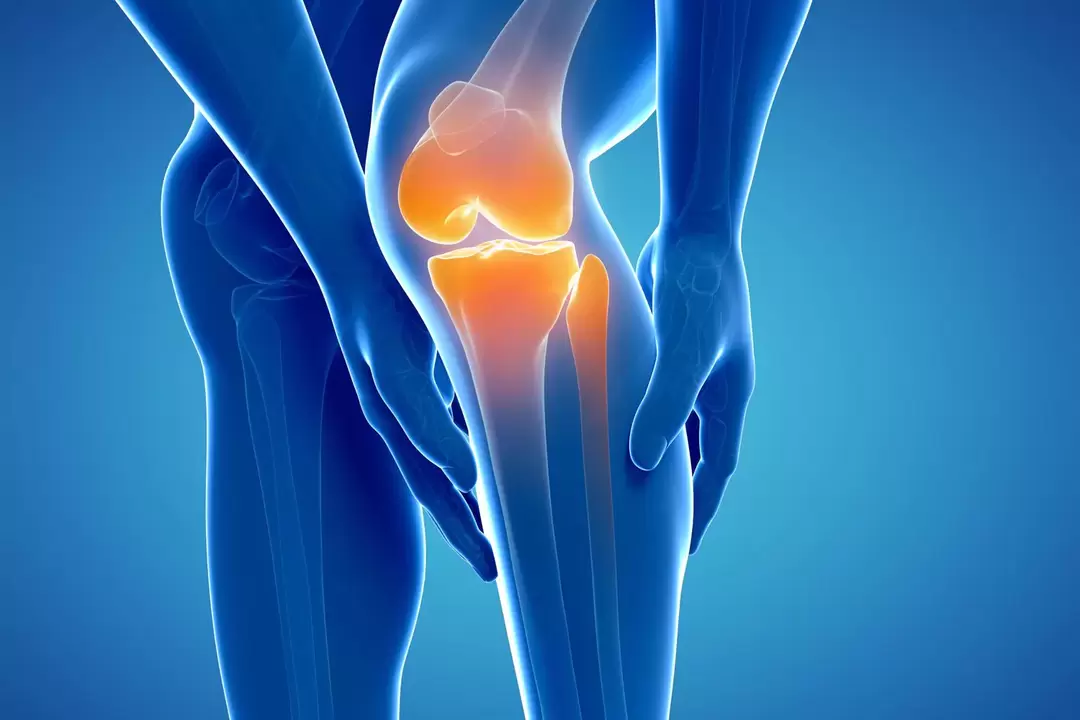 Артроза на колянната става (гонартроза, деформиращ остеоартрит)