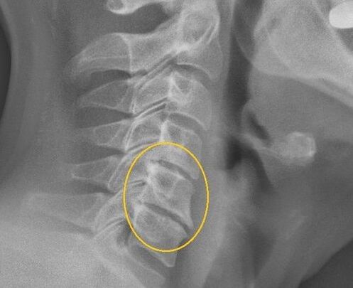 Остеохондроза на шийния гръбначен стълб върху x -ray